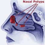 Nasal Polyps